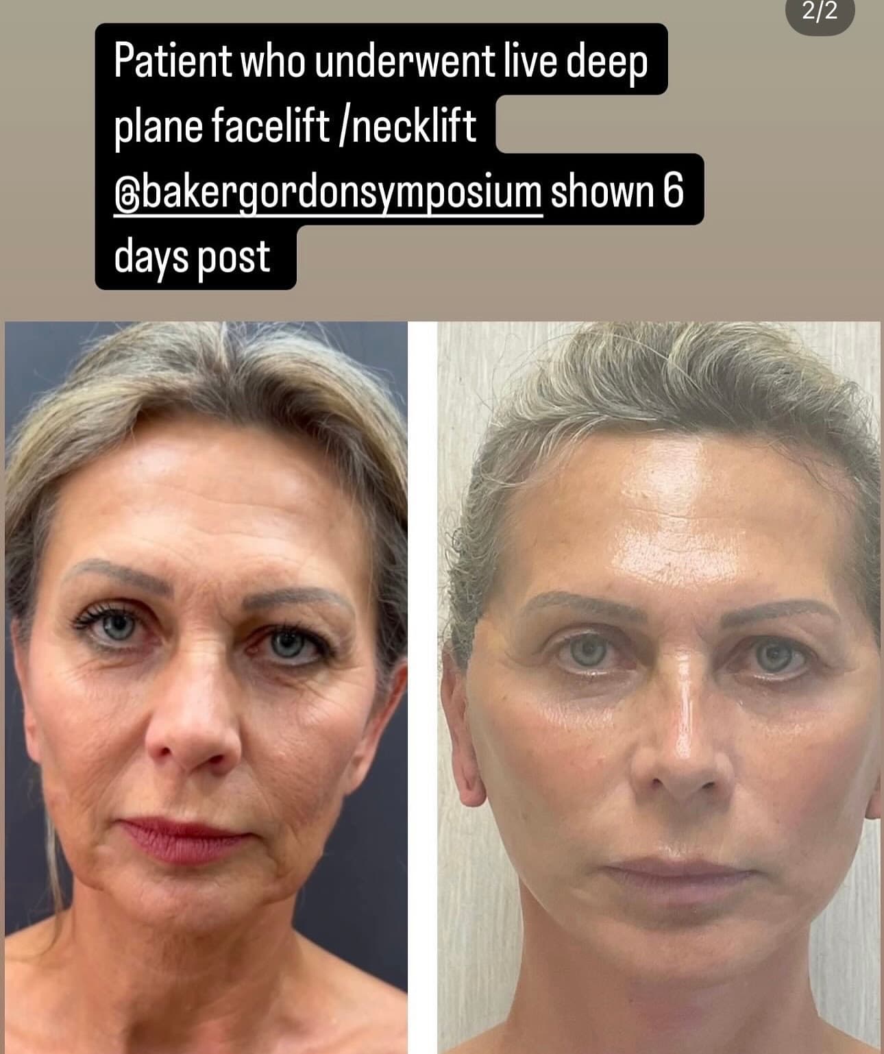Patient recovery results 6 days after live deep plane facelift at Baker Gordon Symposium