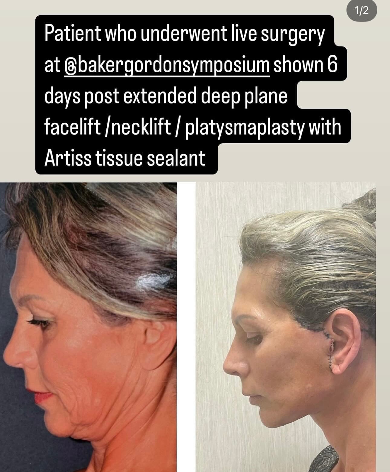 Facelift patient 6 days after Dr. Rizk's live deep plane procedure at the Baker Gordon Symposium