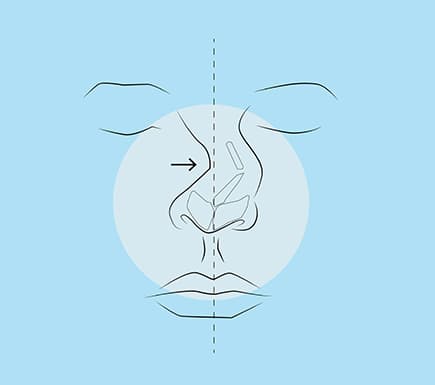 Common Nose Concerns: Broken Nose Surgery