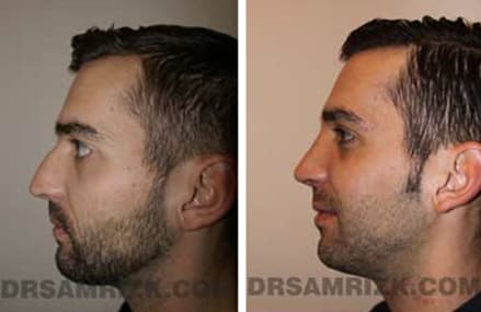 Before and after crooked nose surgery case1