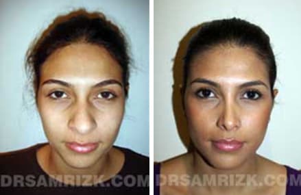 Before and after crooked nose surgery case2