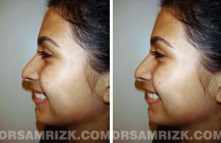 Before and after crooked nose surgery case3