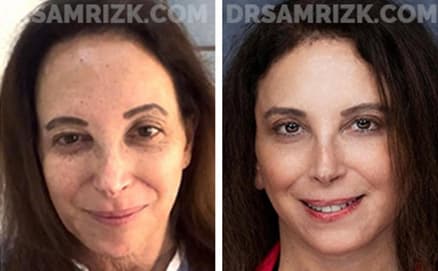 Before and after case1
