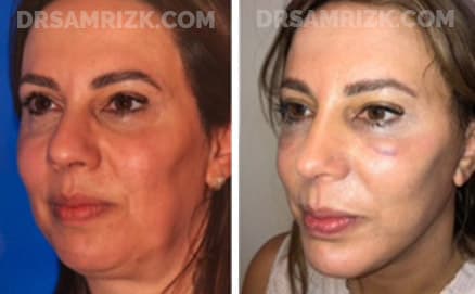 Patient 11 Set1 before and after nose surgery