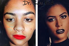 Pt is Ms Angola underwent ethnic RHINOPLASTY with alar base reduction and tip grafts. Patient sent postoperative pictures 2 years after rhinoplasty