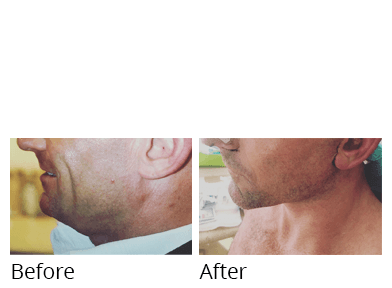 Male face, before and after Facelift and necklift treatment, side view, patient 1