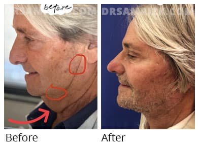 Male face, before and after facelift