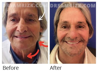 Male face, before and after facelift