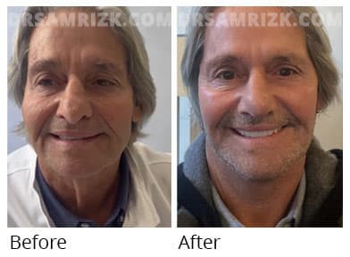 Male face, before and after facelift