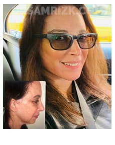 5 th Ave New York plastic surgeon chose Dr Rizk and underwent deep plane facelift / necklift/ browlift and blepharoplasty and sent her picture 3 months post and 6 months post. It's a testament that plastic surgeons chose Dr Rizk for their facelifts.
