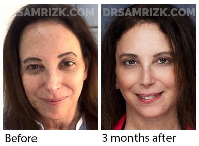 5 th Ave New York plastic surgeon chose Dr Rizk and underwent deep plane facelift / necklift/ browlift and blepharoplasty and sent her picture 3 months post and 6 months post. It's a testament that plastic surgeons chose Dr Rizk for their facelifts.