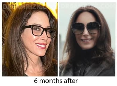 5 th Ave New York plastic surgeon chose Dr Rizk and underwent deep plane facelift / necklift/ browlift and blepharoplasty and sent her picture 3 months post and 6 months post. It's a testament that plastic surgeons chose Dr Rizk for their facelifts.