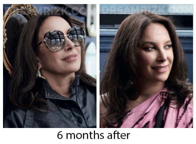 5 th Ave New York plastic surgeon chose Dr Rizk and underwent deep plane facelift / necklift/ browlift and blepharoplasty and sent her picture 3 months post and 6 months post. It's a testament that plastic surgeons chose Dr Rizk for their facelifts.