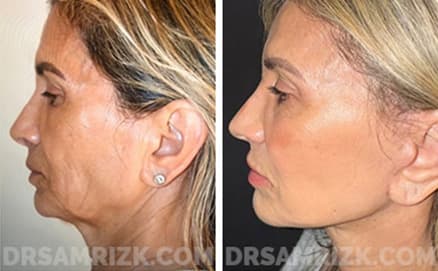Before and after case9