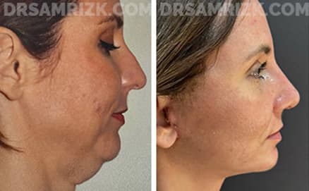 Before and after case8
