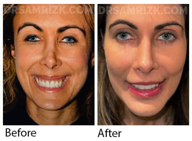 This is a patient who underwent revision rhinoplasty with MtF rib bank cartilage and fascia, shown 6 months post-surgery. Issues repaired include: Open roof deformity, Crookedness, Pollybeak deformity and Inverted V deformity (front view)