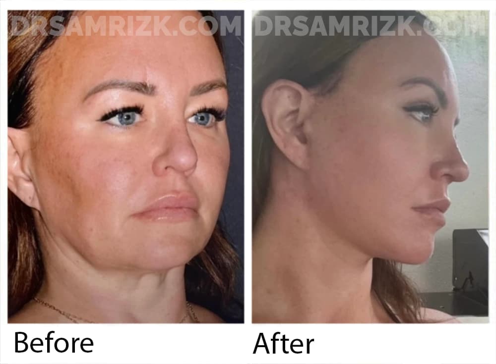 44 yo patient underwent deep plane facelift / necklift / endoscopic browlift / upper and lower blepharoplasty/ revision rhinoplasty with rib / lip lift bullhorn and laser from out of town . She sent her own postoperative pictures 3 months post. She is still mildly swollen but will continue to improve.