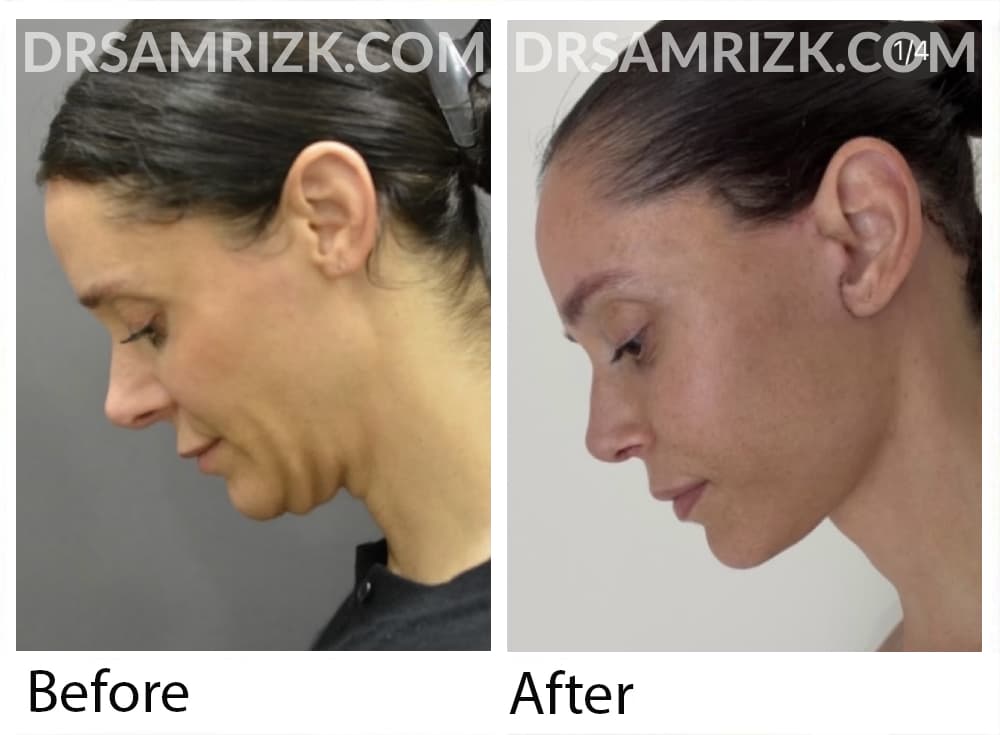 This 41 yo patient shown 2 weeks post deep plane facelift / Necklift 1