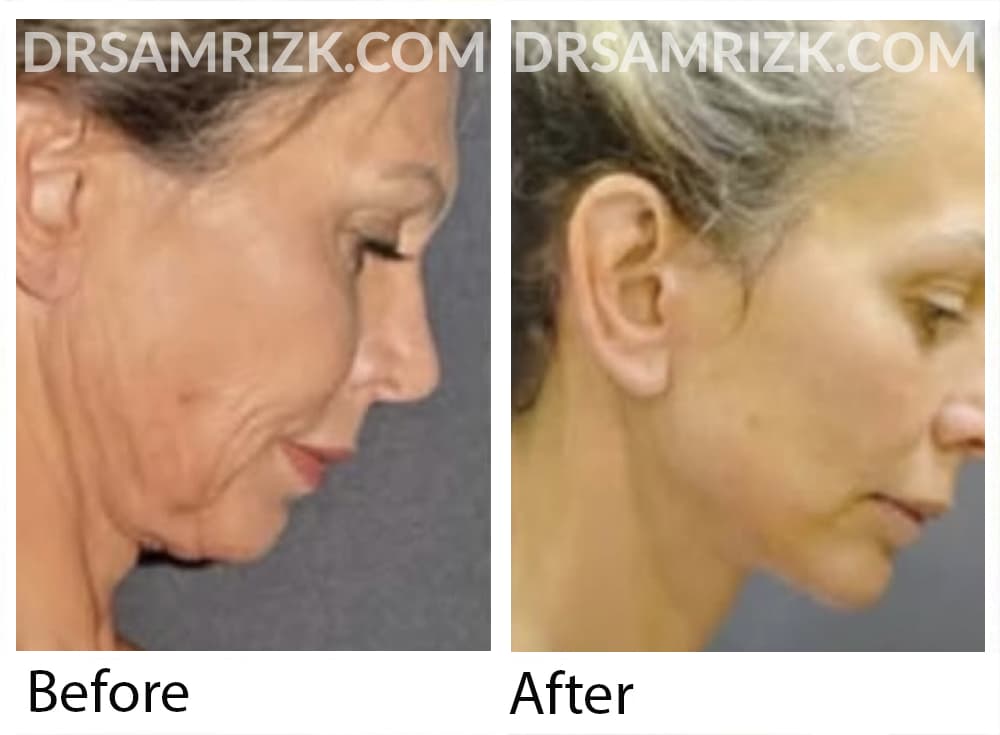 55 yo patient show 1 year post deep plane facelift / necklift performed live at Baker Gordon Symposium. Dr Rizk performed his novel rapid recovery deep plane facelift in front of thousands of plastic surgeons to teach most advanced techniques. 1