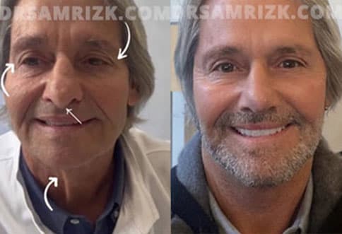 photos male patient Before and After Facelift