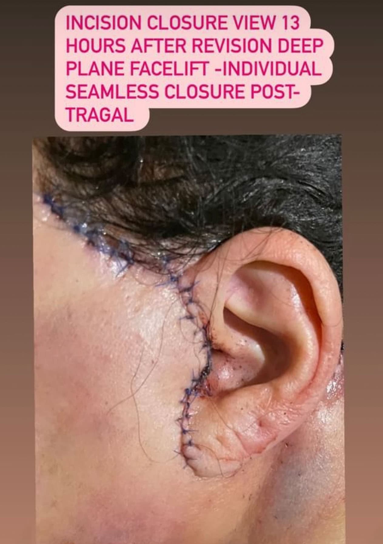 facelift scars ba2