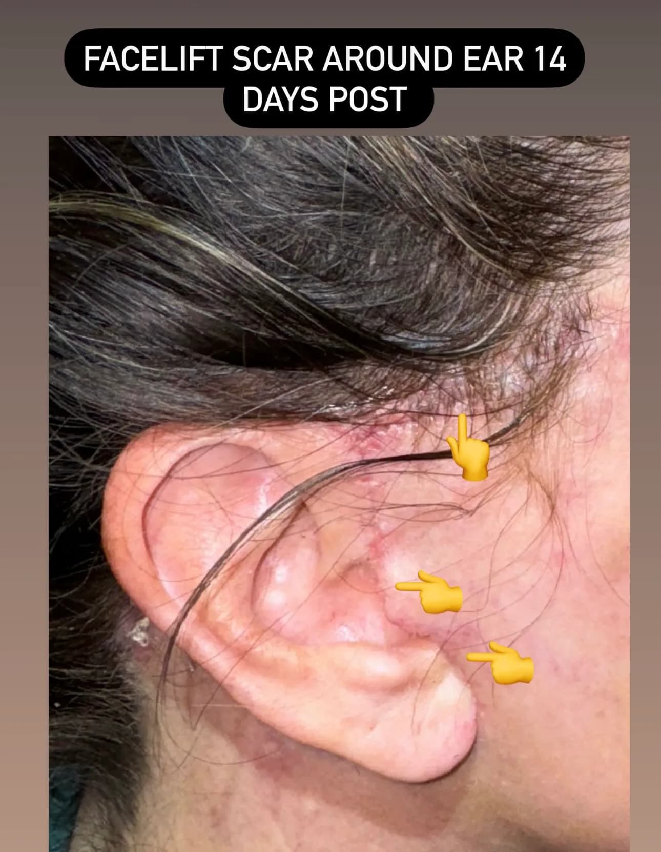 Early Healing Phase | Facelift Scars After 2 Weeks