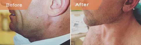 Female face, Before and After Neck Lift treatment, oblique view, patient 1
