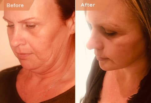 Female face, Before and After Neck Lift treatment, oblique view, patient 1