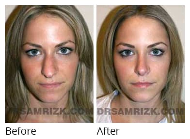 Female face, before and after Rhinoplasty treatment, front view (patient 2)