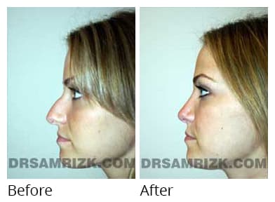 Female face, before and after Rhinoplasty treatment, l-side view (patient 2)