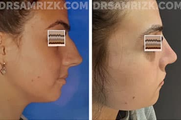 1 year post teenager rhinopasty