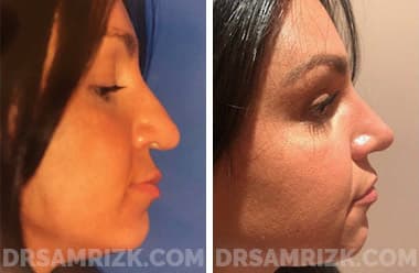 Patient face, before and after revision rhinoplasty, set 1, patient 1