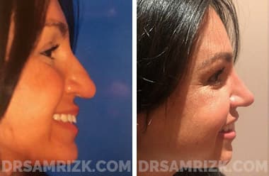 Patient face, before and after revision rhinoplasty, set 2, patient 1
