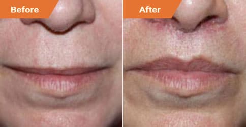 Woman's face, Before and After Lip Enhancement Treatment, lips, front view, patient 4