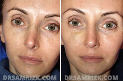 Patient face, before and after revision rhinoplasty, set 1, patient 4