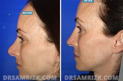 Patient face, before and after revision rhinoplasty, set 2, patient 4