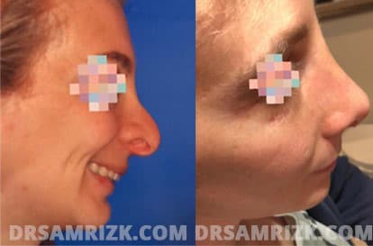 Patient face, before and after revision rhinoplasty, set 1, patient 5
