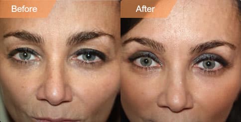 photos Female patient Before and After Facelift