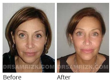 Female face, before and after Eyelids surgery, front view, patient 8