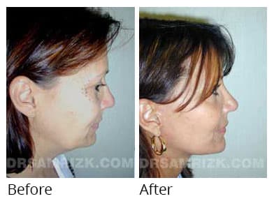 Female face, before and after Eyelids surgery, side view, patient 9
