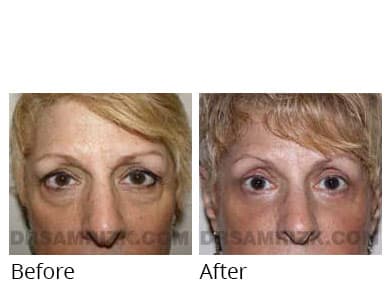 Female face, before and after Eyelids surgery, front view, patient 12