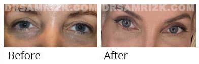 History 39 yo wife of nyc plastic surgeon Dr. Ryan Neinstein underwent upper and lower blepharoplasty for redundant skin and bags shown at different stages of healing. Last 2 pictures patient sent 1 month after.