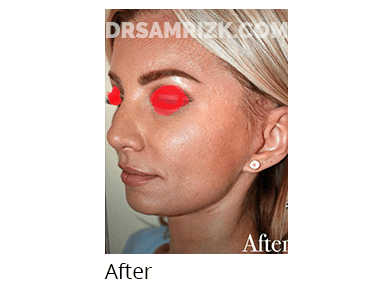 Female face, after Facelift and necklift treatment, oblique view, patient 3