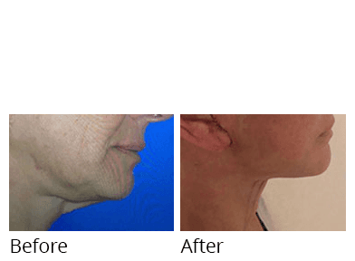 Female face, before and after Facelift and necklift treatment, side view, patient 11