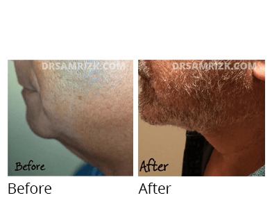 Male face, before and after Facelift and necklift treatment, side view, patient 12