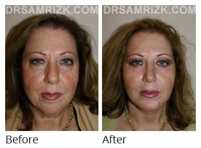 Female face, before and after Facelift and necklift treatment, front view, patient 16