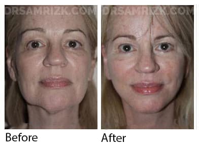 Female face, before and after Facelift and necklift treatment, front view, patient 42