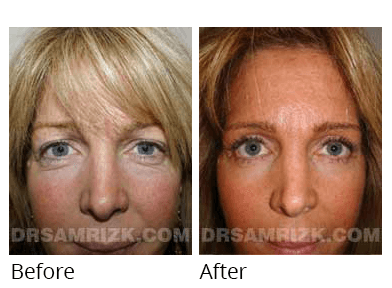 Female face, before and after Facelift and necklift treatment, front view, patient 45
