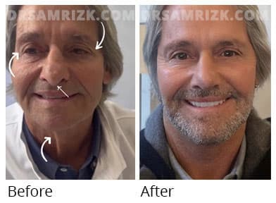Male face, before and after facelift