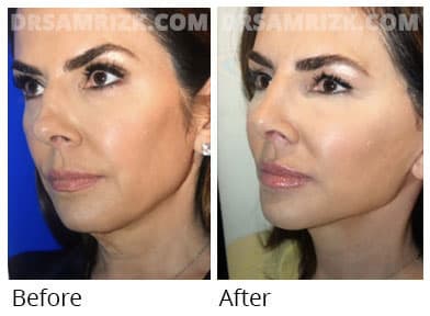 Female face, before and after Facelift, oblique view, patient 48